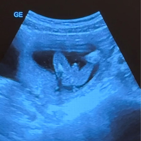 16 weeks ultrasound Gender Baby