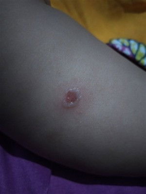 Bun ini kenapa yah awal ny Kya bintik biasa ko Kya meletus hbis tu luka ny tambah besar