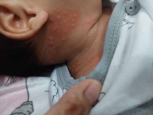 Bruntusan m3reh di wajah dan leher