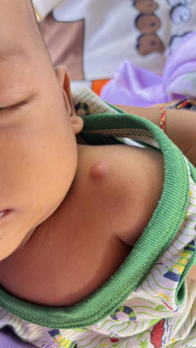 ตุ่มตรงไหล่คืออะไรคะ