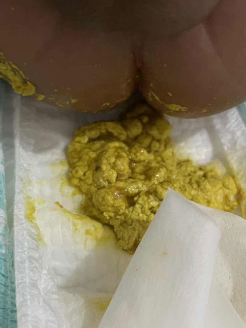 2 month old- diarrhea?