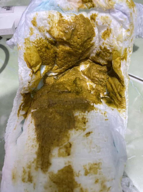 warna tinja yang normal ?