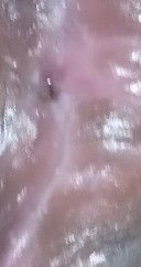 Jahitan sehabis lahiran