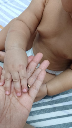 Ibu jari anak tidak terbuka sepenuhnya. Adakah normal? Mohon bantuan.