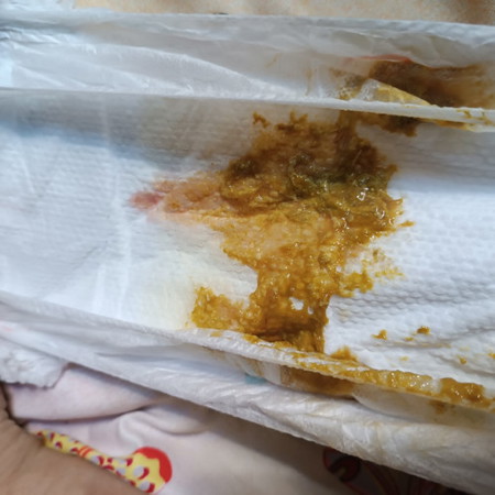 Baby Diarrhea. Normal ba ito?