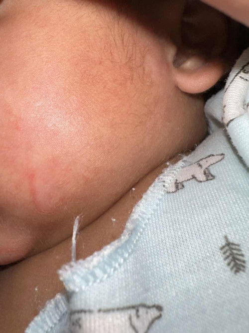 Cara mengatasi ruam seperti ini?