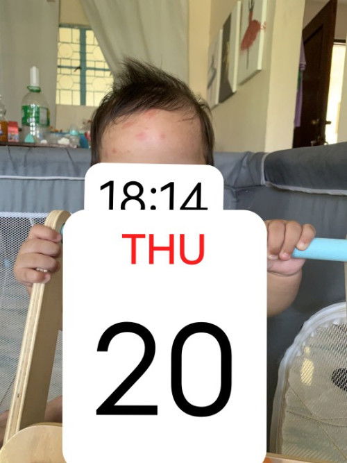 Hello sino po may same case sa bb ko may pula sa noo. Pumupula ng ganyan pag mainit at pawisan siya