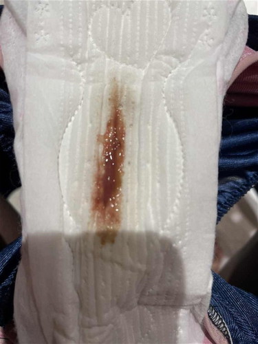 Note: Picture of bloody pad. Is this lochia?