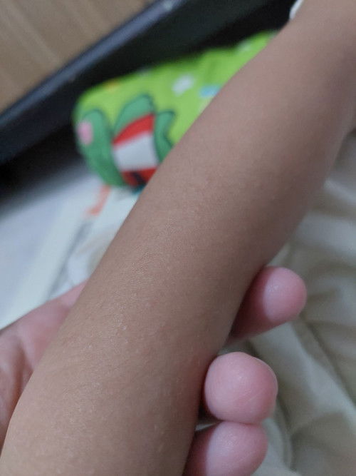 Kulit anak bruntus ruam