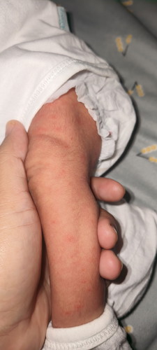 Hi Momsh ! Normal lng ba to sa NB my lumalabas na red dots sa skin Niya pero sa legs Niya lng Po.