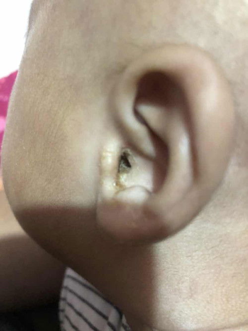 Telinga bayi usia 2 bulan