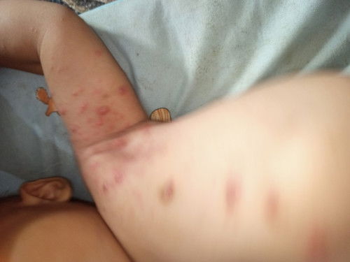 Anak 8 bulan kena scabies / gatal gatal,