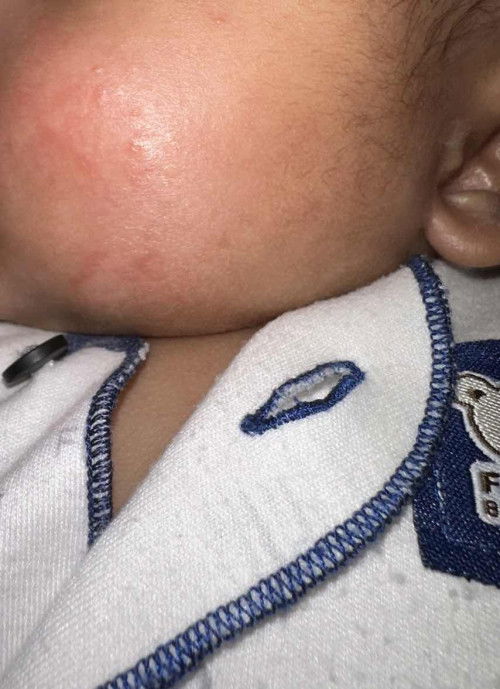 Ruam pipi atau alergi yah bun?