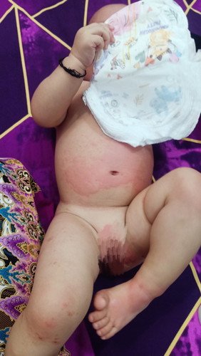 Pula pula sa katawan ni baby