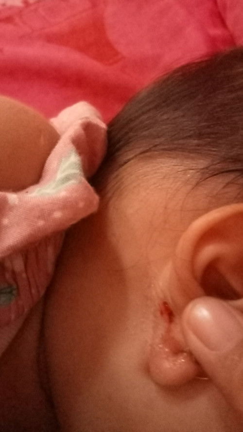 Iritasi di bagian tindik telinga