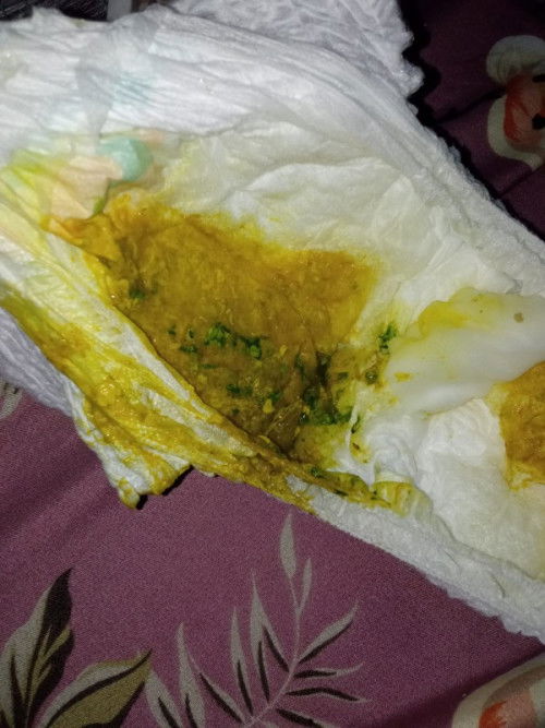 minta pendapat , pup kaya gini ada 4x g banyak . 2 HR kmren demam , udah diresepin zink sama dokter