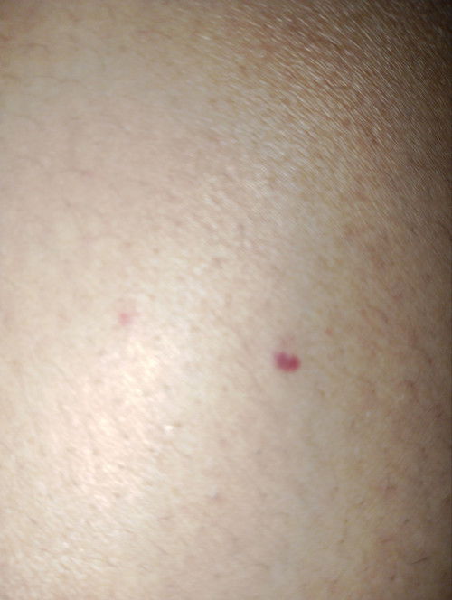 Ada bercak di paha seperti darah tapi di dalam kulit