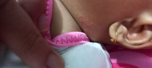 Kulit bayi bintik merah melingkar