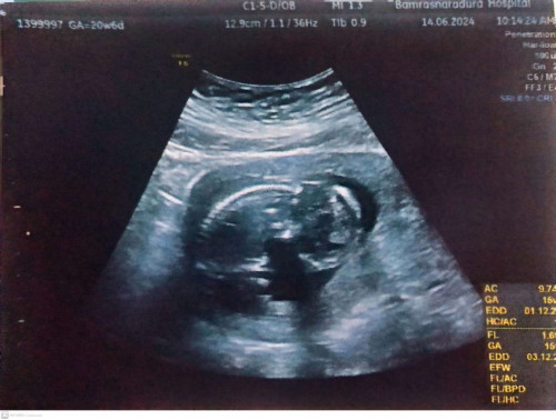 ตอนนี้ 16w5d เจ็บจี๊ดๆนิดหน่อยค่ะเหมือนลูกดิ้น แต่ก็แอบสะดุ้ง แม่ๆมีใครเป็นบ้างคะ