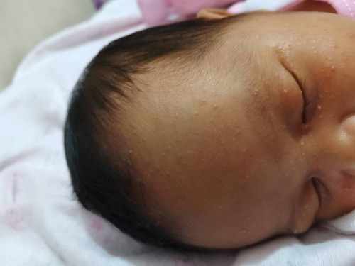 Baby rashes sa face