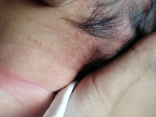 อยากสอบถามเเม่ๆ เเบบนี้เขาเรียกผื่นอะไรค่ะ ขึ้นที่หัวที่คอเเละใบหูน้องค่ะ