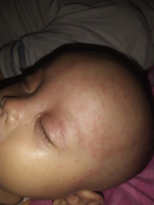 Alergi atau biangkeringat ?