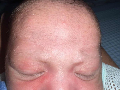 Baby 19 hari dah .. tapi yg dkt muka tu kulit kering bila eh hilang? Kene apply apa ii ke ?