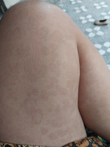 Bun mau nnya umur 35w kulir terutms kaki begitu itu knp ya? Obtnya apa ya gatel jg si
