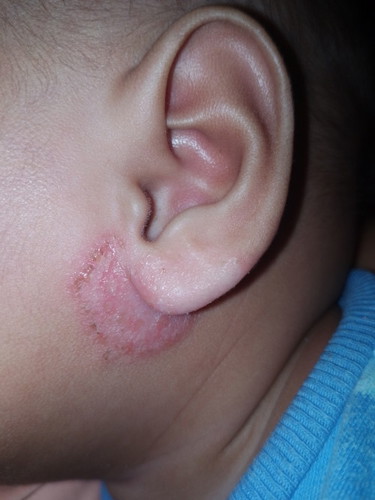 Round rash on ears