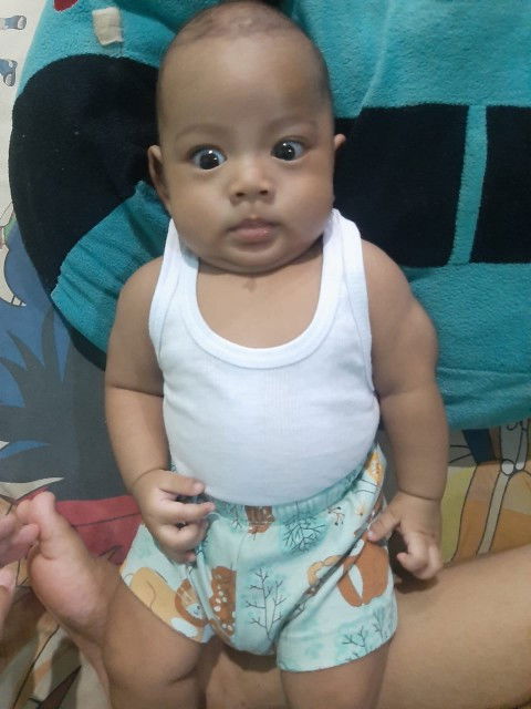 Bayi umur 2 bulan 21 hari mata juling