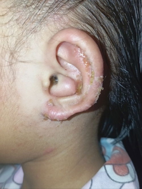 Telinga anak gatal,berkerak,dan berair