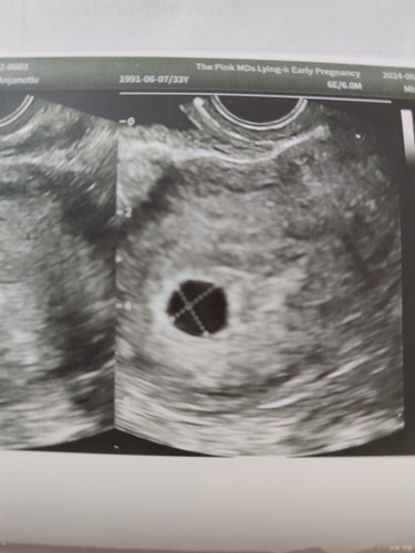 NO FETUS AT 8 WEEKS