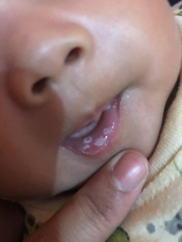 Sariawan pada bayi