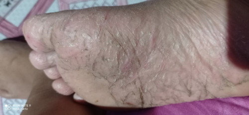 sakit kaki pecah
