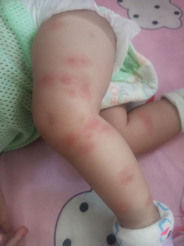 Red spots kay baby