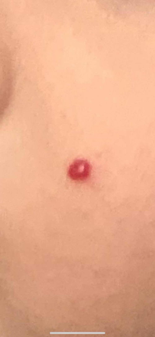 Red mole or Butlig?