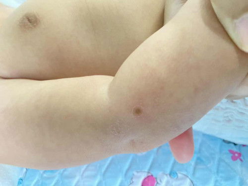 ผิวที่แขนน้องเป็นแบบนี้ คืออะไรหรอคะ อันตรายไหมคะ