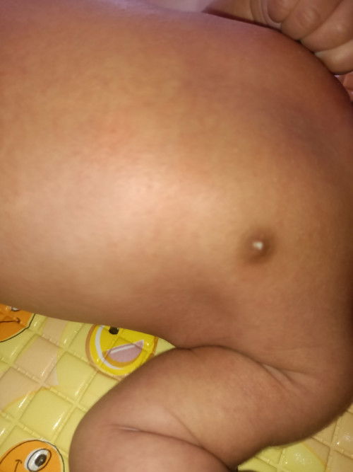 Bintik putih di payudara bayi