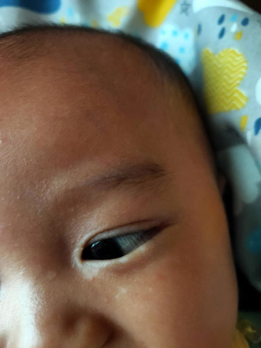 Bercak putih pinggir mata