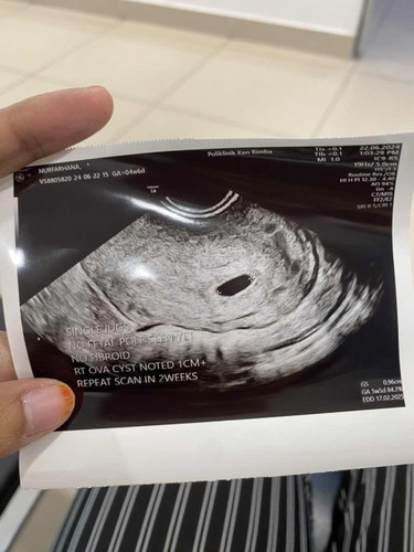 cyst 1 cm semasa mengandung