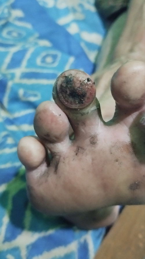 Maaf melenceng ttg penyakit org dewasa