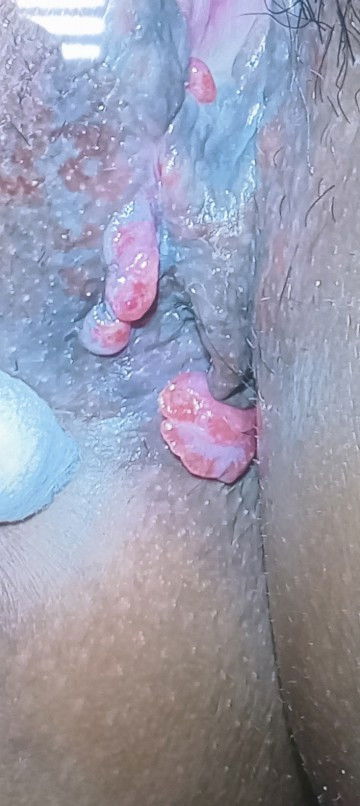 หูดจริงหรือเปล่าคะ