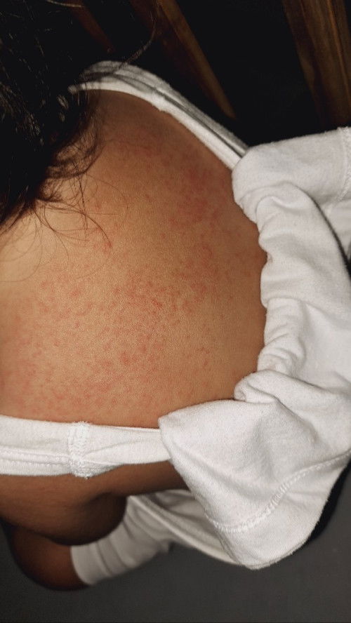 Rashes sa katawan ni baby