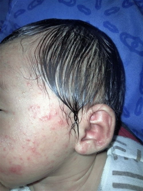 Bruntusan di area muka Newborn sensitif