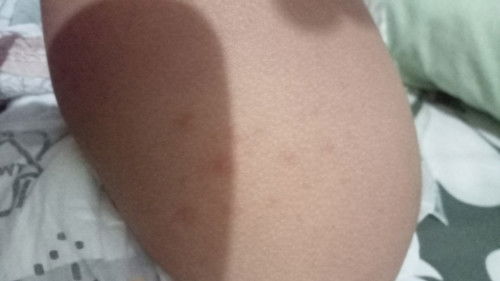 Cacar pada anak 1 tahun