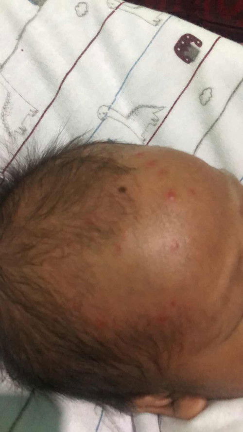 Obat krim digigit nyamuk