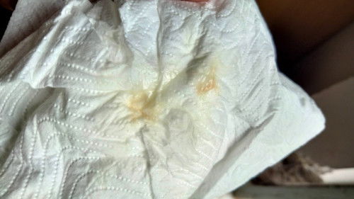 เป็นมูกเหมือนมีเลือดปนแบบนี้ปกติมั้ยคะ