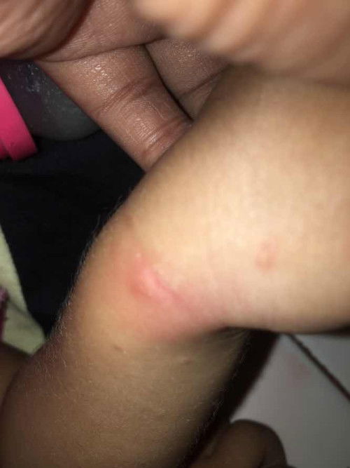 Bintik gatal pada anak