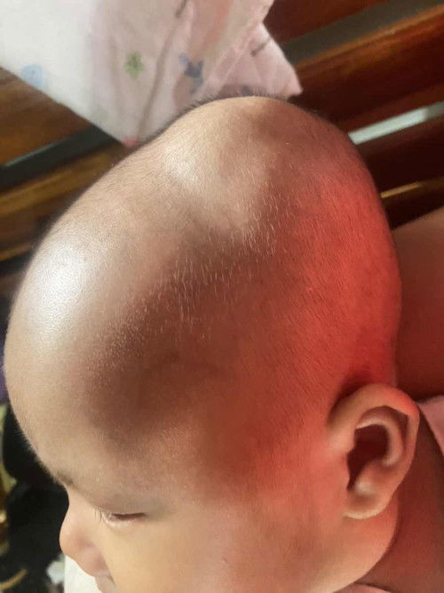 หัวโนบวม จากการคลอด (คลอดธรรมชาติ)