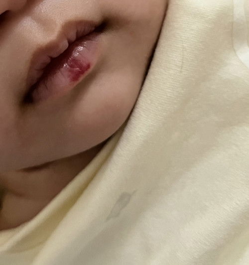 หนูน้อยคนไหนเคยเป็นบ้างคะ